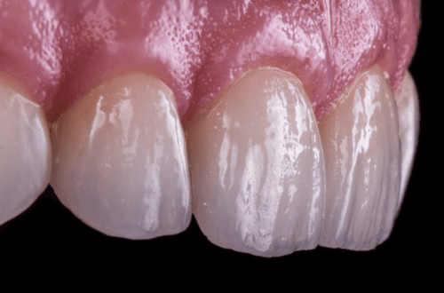 coroane dentara integral ceramice